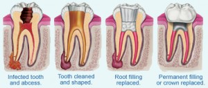 root-canal