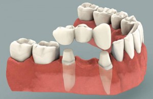 dental-bridge